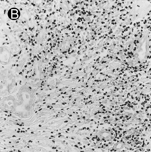Fig. 3. Cutaneous nasal-type NK/T-cell lymphoma (case no. 34). (A) This biopsy was initially misinterpreted as vasculitic lesion because of the small size of the lymphoid cells and the minimal cellular atypia. (B) Large numbers of lymphoid cells in the skin show positive labeling for EBERs on in situ hybridization. The sweat gland in the left field is negative.