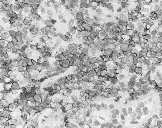Fig. 4. Cutaneous nasal-type NK/T-cell lymphoma, with the lymphoma cells showing cell membrane staining for CD56 on paraffin section. The sweat gland in the lower field is not stained.