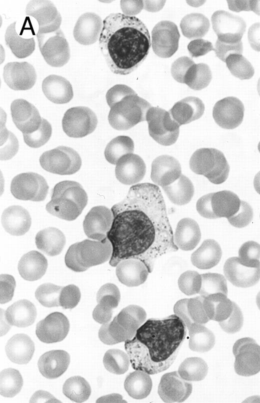 Fig. 5. Two different cases of aggressive NK cell leukemia/lymphoma. (A) Peripheral blood shows increased large granular lymphocytes, most of which are mature-looking (case no. 36). The cell in the center is slightly less mature. (B) Buffy coat smear shows immature large granular lymphocytes with more open chromatin and distinct nucleoli (arrows) (case no. 37). Myeloid cells are seen in the background.