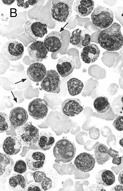 Fig. 5. Two different cases of aggressive NK cell leukemia/lymphoma. (A) Peripheral blood shows increased large granular lymphocytes, most of which are mature-looking (case no. 36). The cell in the center is slightly less mature. (B) Buffy coat smear shows immature large granular lymphocytes with more open chromatin and distinct nucleoli (arrows) (case no. 37). Myeloid cells are seen in the background.
