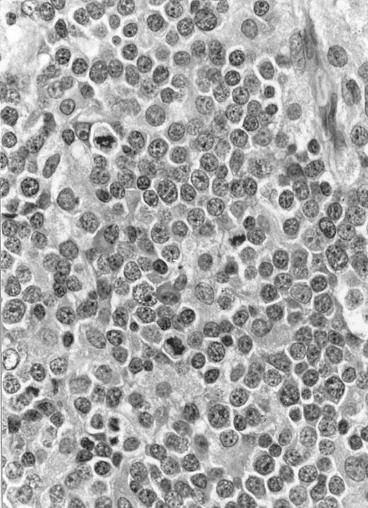 Fig. 6. Lymph node biopsy of aggressive NK cell leukemia/lymphoma (case no. 37). There is a fairly monotonous, diffuse infiltrate of medium-sized cells with round nuclei. The neoplastic cells in this case resemble plasmacytoid monocytes.