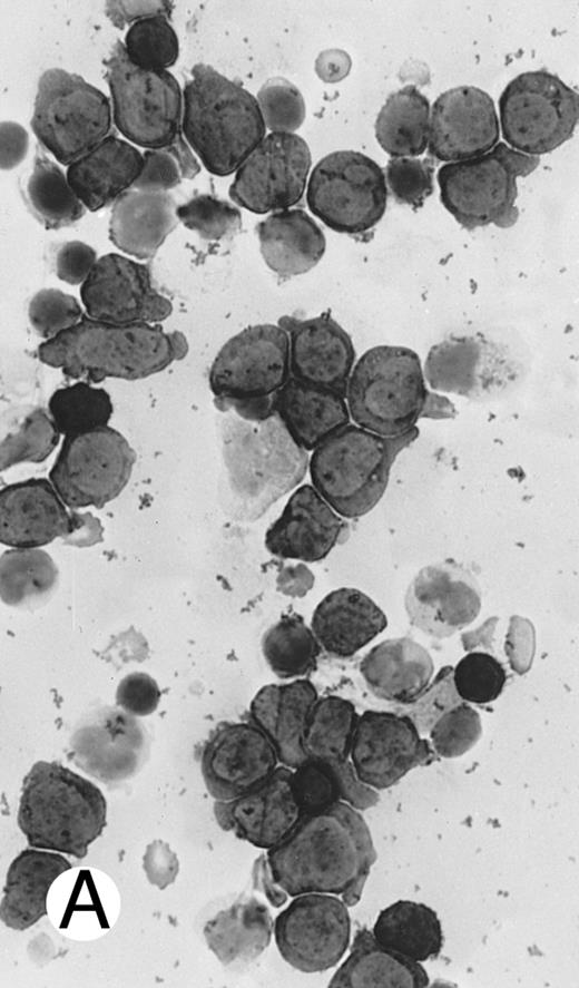 Fig. 7. Immunocytochemical staining of aggressive NK cell leukemia/lymphoma (case no. 39), using the labeled avidin-biotin alkaline phosphatase system. The smears were prepared from mononuclear cells separated by density gradient centrifugation using Ficoll-Isopaque. (A) The cells are positive for CD2. (B) There is no reactivity for Leu4/CD3; the strongly stained small lymphocytes serve as internal positive controls. (C) The cells are reactive for CD56 (NKH1).