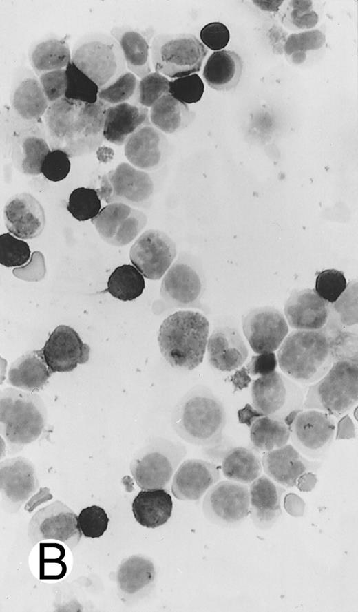 Fig. 7. Immunocytochemical staining of aggressive NK cell leukemia/lymphoma (case no. 39), using the labeled avidin-biotin alkaline phosphatase system. The smears were prepared from mononuclear cells separated by density gradient centrifugation using Ficoll-Isopaque. (A) The cells are positive for CD2. (B) There is no reactivity for Leu4/CD3; the strongly stained small lymphocytes serve as internal positive controls. (C) The cells are reactive for CD56 (NKH1).