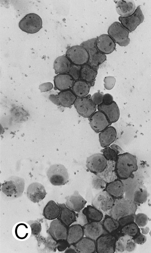 Fig. 7. Immunocytochemical staining of aggressive NK cell leukemia/lymphoma (case no. 39), using the labeled avidin-biotin alkaline phosphatase system. The smears were prepared from mononuclear cells separated by density gradient centrifugation using Ficoll-Isopaque. (A) The cells are positive for CD2. (B) There is no reactivity for Leu4/CD3; the strongly stained small lymphocytes serve as internal positive controls. (C) The cells are reactive for CD56 (NKH1).