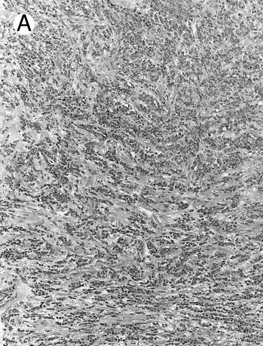 Fig. 8. Blastoid NK cell lymphoma (case no. 40). (A) Biopsy shows a diffuse lymphomatous infiltrate with a prominent single-file pattern. (B) The neoplastic cells are medium-sized and possess fine chromatin. Mitotic figures are seen. There is remarkable resemblance to myeloid leukemic infiltration.