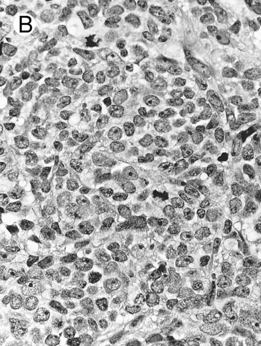 Fig. 8. Blastoid NK cell lymphoma (case no. 40). (A) Biopsy shows a diffuse lymphomatous infiltrate with a prominent single-file pattern. (B) The neoplastic cells are medium-sized and possess fine chromatin. Mitotic figures are seen. There is remarkable resemblance to myeloid leukemic infiltration.
