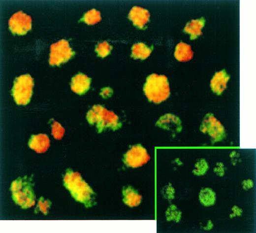 Fig. 5. Confocal analysis of double immunofluorescence assay on EBV-transformed T cells. EBV transformed T cells (NC5) were labeled with the anti-LMP–1 MoAb revealed by a phycoerythrin-ABC complex and by an anti-CD3 MoAb revealed by a fluorescein-goat antimouse immunoglobulin F(ab)′2. Cells labeled with the IgG1 control isotype and the CD3 MoAbs are shown in the bottom left corner as a control. Cells were analyzed with a confocal microscope. The green color represents the fluorescein-labeled CD3 MoAb, the red color represents the phycoerythrin-labeled anti-LMP–1 MoAb, and the yellow color represents the mixture of the two colors as detected by the confocal microscope.
