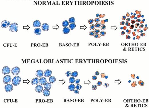 Fig. 6. Pathophysiologic model of megaloblastic anemia based on apoptosis at the basophilic and polychromatophilic erythroblast stages that produce large reticulocytes. Cells appear as stained with 3,3′-dimethoxybenzidine and hematoxylin. Apoptotic cells are indicated by condensed and fragmented nuclei. See text for description.