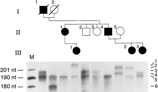 Fig. 5. Analysis of simple sequence repeat polymorphism. The pedigree of the affected kindred is shown at the top of the figure. DNA for study was available from two deceased individuals (I-1 and I-2) as well as from the living family members. DNA 5′ to the EpoR gene translation initiation site contains a microsatellite repeat polymorphism182223 and this region of DNA was amplified by PCR and the products fractionated by polyacrylamide gel electrophoresis. Most individuals have two differently sized alleles that correspond to the inherited parental copies of the EpoR gene, one from each parent; two individuals (II-1 and II-4) display only one band, consistent with homozygosity for two alleles of the same size. Six alleles were observed and are numbered in order of decreasing size. The two affected individuals in the second generation (II-1 and II-4) share allele 5 inherited from their affected father (I-1) as well as an allele of the same size from their unaffected mother (I-2). The two unaffected individuals in the second generation (II-2 and II-3) must have inherited allele 5 from their mother (I-2). Thus, allele 5 inherited from the father (I-1) cosegregates with the disease phenotype.