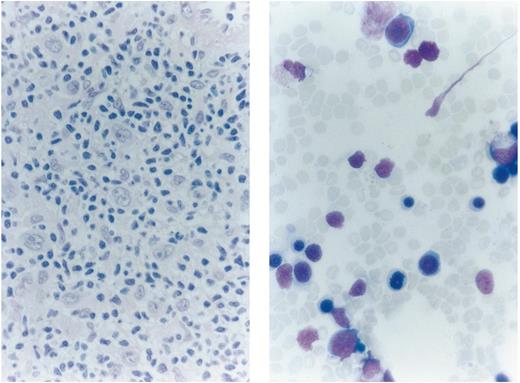 Extensive bone marrow infiltration by Hodgkin's lymphoma. On trephine biopsy, there is replacement of normal hematopoietic cells by Reed-Sternberg and mononuclear Hodgkin's cells, surrounded by small lymphocytes and a fibroblastic reaction. Bone marrow aspirate shows infiltration by mononuclear Hodgkin's cells. (Courtesy of P.T. Murphy and C.S. Chapman, Department of Haematology, Leicester Royal Infirmary, Leicester, UK.)