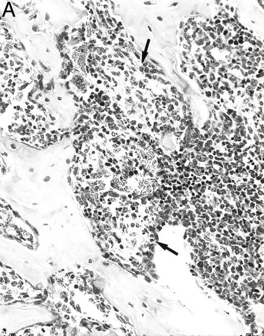 Fig. 4. Bone marrow alterations in IFN-γ transgenic mice. (A) Tibial bone marrow of a 3-month-old transgenic mouse showing granulomatous lesions (arrows) stained with H&E. The focal lesions were composed of clusters of histiocytes/macrophages (original magnification × 300; Bouin's fixed and paraffin-embedded section). (B) A rib of an 8-month-old transgenic mouse showing a cartilaginous mass in the marrow cavity attached to the cortical bone. Chondrocytes in the mass are degenerative. The mass is covered with a thin osseous layer. (Original magnification × 75; H&E; Bouin's fixed and paraffin-embedded section.)