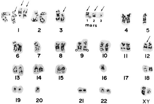 Fig. 2. Karyotype from patient 7 shows the complex karyotype, -4 5 , X Y , d e l ( 1 ) ( p 2 2 ) , ;k1 d e l ( 1 ) ( q 1 2 ) ;k4 2 , d e l ( 3 ) ( p 1 1 ) , ;k2 5 , ;k2 7 , d e l ( 1 2 ) ( p 1 1 ) , ;k2 1 6 , ;k2 1 7 , ;k2 1 7 , ;k2 2 0 , ;k1 m a r 1 , ;k1mar2,;k1mar3. Arrows show chromosomes with structural aberrations. Open circles (;pe) indicate the locations of the ABL oncogene detected by FISH from the same Carnoy's solution. Two signals were located on two homologues of chromosome 9, one on derivative chromosome 1, and one on a marker chromosome. Mars corresponds to marker chromosomes.