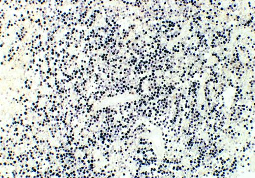 Fig. 1. Mexican Burkitt's lymphoma. In situ hybridization reveals EBER1/2 transcripts in virtually all viable tumor cells. Necrotic cells are unstained. Case no. 9, original magnification ×100. Color development with NBT/BCIP substrate.