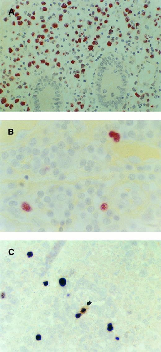 Fig. 2. Intestinal T-NHL. (A) T-NHL, non-EATCL type. The vast majority of the neoplastic cells show strong expression of EBERs. Crypts are largely spared by the tumor cells. Case no. 1, original magnification ×400. (B) T-NHL, EATCL-like. Occasional large cells clearly identifiable as neoplastic show strong EBER expression. Case no. 7, original magnification ×1000. (C) T-NHL, non-EATCL type. A single small bystander cell (arrow) shows coexpression of EBERs and CD20 (L26). Some neoplastic large T cells lacking CD20 expression are positive for EBERs. Double staining for L26 (brown) and EBERs (black). Case no. 8, original magnification ×1000.