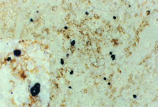 Fig. 3. Follicle center cell lymphoma, double staining for CD20 (L26) and EBERs. The large, atypical EBER-positive blasts in the center of a neoplastic follicle do not express CD20. These cells were also negative for UCHL-1. Case no. 11, original magnification ×400. Inset, occasionally smaller cells (arrow) showed coexpression of EBERs and CD20. Original magnification ×1000.