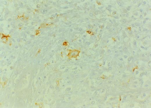 Fig. 4. Diffuse large B-cell lymphoma of Mexican origin, EBER-negative. Some large blasts reminiscent of Hodgkin cells strongly express LMP-1. Original magnification ×400.