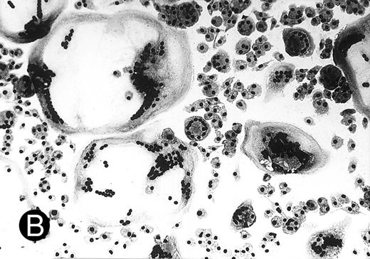 Fig. 3. (A) MGC derived from freshly isolated monocytes (day 0) stimulated with conditioned medium for 3 days. Giemsa, original magnification × 25. (B) Generation of MGC with PMA and HLA class II MoAb. Monocytes were cultured for 6 days in the presence of 10% human serum before stimulation. Giemsa, original magnification × 25.