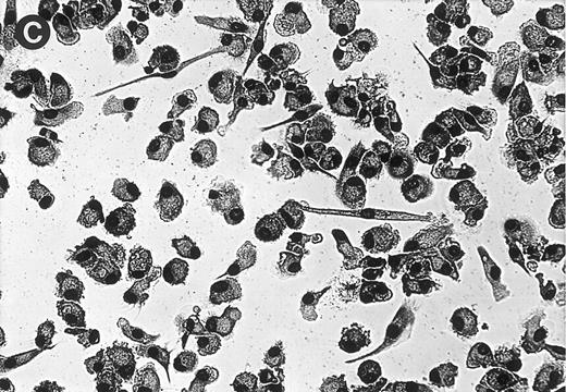 Fig. 4. Fig 4 (cont'd). (A) Influence of monocyte to macrophage maturation on the formation of MGC. Monocytes were cultured with (•) and without (▿) human serum to induce/prevent macrophage maturation and stimulated with conditioned medium. Six different media were compared (Ultradoma-PF, Ultradoma, RPMI 1640, SF3, CG, and RG, the latter two inducing monocyte maturation by themselves). Each point represents the mean of six experiments performed with cells obtained from different donors. Deviations from the mean are caused mainly by the donor variability found on day 0 (fusion rates ranging from 55% to 90%). The capacity to fuse is gradually lost during maturation. Asterisks indicate statistically significant differences between cultures with and without human serum (*P < .05, **P < .01). Two typical examples are shown in the photographs. Following culture in protein-free medium (Ultradoma-PF ) without (B) or in the presence of (C) human serum, formation of MGC is still possible (B) or markedly reduced (C). Stimulation was performed on day 5. Giemsa, original magnification × 50.