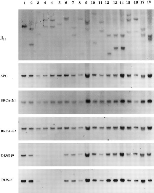 Fig. 1. Representative examples of Southern blot analysis of CLL patients. A panel of probes were used for the investigation of clonality (IgH joining region probe), control or loading of total DNA (APC probe), deletion of 13q14.3 region (D13S25 and D13S319 marker probes), and deletion of 13q12 (BRCA2 probe for exon 11, BRCA2-1 and exon 26-27, BRCA2-2, respectively). Except for the patients in lanes 9, 15, and 16 (with <90% clonal B cells population as determined by the JH pattern), all of the other patients are representative examples of patterns included in this study.