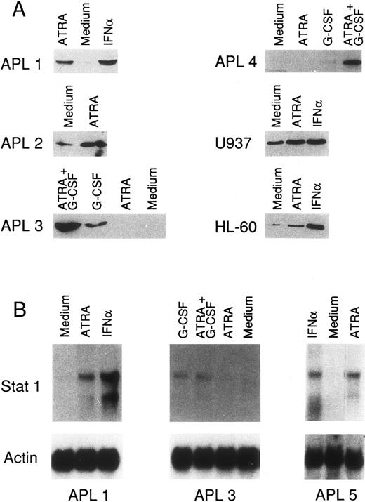 Fig. 3. Effects of ATRA, IFNα, G-CSF and the combination of G-CSF and ATRA on Stat 1α protein and Stat 1 mRNA in freshly isolated APL cells and the two myelogenous leukemia cell lines U937 and HL-60. (A) Leukemic cells obtained from the BM of 4 different APL patients, U937 and HL-60 cells were seeded at a concentration of 4 × 105/mL and treated for 4 days as indicated. Cells were obtained, lysed, and the cell extracts (10 μg of protein/lane) subjected to Western blot analysis, using antibodies specific for Stat 1α. (B) Freshly isolated leukemic cells (4 × 105/mL) from three APL patients were treated for 4 days, as indicated. Total RNA was isolated and subjected (20 μg/lane) to Northern blot analysis. Filters were sequentially hybridized with cDNA probes coding for Stat 1α and β-actin. For all the experiments shown, the following stimuli were used: ATRA (10−6 mol/L), G-CSF (10 ng/mL), the combination between ATRA and G-CSF, and IFNα (1,000 U/mL).