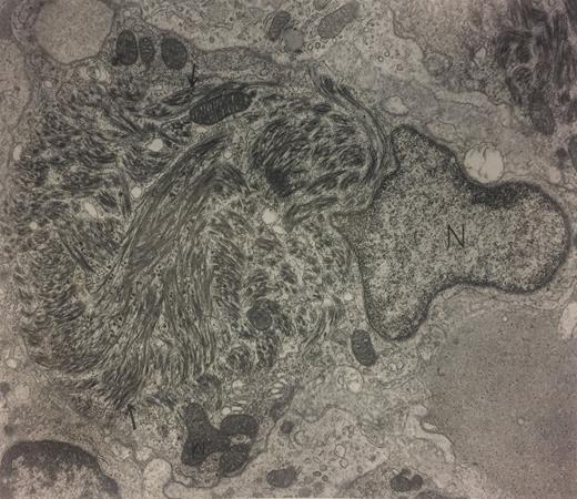 Waldenström's macroglobulinemia. Dense fibrillar and globular material (arrows) fills dilated cisternae of rough endoplasmic reticulum in a bone marrow plasma cell. By light microscopic immunoperoxidase, these inclusions contained IgM-κ, the same monoclonal Ig that was detected in the patient's serum. N, nucleus; M, mitochondria. (Original magnification × 12,500.) (Courtesy of Ann M. Dvorak, MD, Department of Pathology, Beth Israel Hospital, Harvard Medical School, 330 Brookline Ave, Boston, MA 02215.)