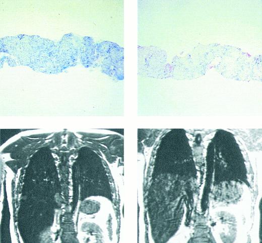 Fig. 3. Prussian blue stain showing (top figures) hepatic iron in hepatocytes and portal macrophages, before (left) and after (right) 9 months of chelating therapy with the orally active chelating agent deferiprone in a patient with homozygous β thalassemia. Hepatic iron concentration in the sample on left was approximately 16 mg/g dry weight liver tissue; in that on the right hepatic iron concentration was less than 2 mg/g dry weight tissue. Coronal MRI (lower figures) of hepatic iron before (left) and after (right) therapy with the orally active iron chelating agent deferiprone in the same patient. Complete absence of liver signal in the MRI on the left is compatible with significant iron deposition, while improvement in signal intensity after 9 months of therapy (right) indicates that the liver iron content is reduced compared with that of the previous study. (Reprinted with permission.192 )