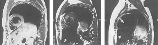 Fig. 4. Sagittal MRI of the heart in three patients with homozygous β thalassemia and transfusional iron overload. (A, left) Normal signal from the septum (long arrow) and posterior wall of the heart, consistent with the presence of very mild cardiac iron loading, in a transfused patient regularly complianct with iron chelating therapy. The homogenous signal of the liver, consistent with very mild iron loading in this organ (short arrow), is also seen below the image of the heart. (B, middle): Imhomogenity of signal from the septum (long arrow) and posterior wall, consistent with moderate iron deposition in a transfused patient erratically compliant with iron chelating therapy. Loss of liver signal (short arrow) is consistent with heavier iron loading in this organ. (C, right): Absence of signal from the septum (arrow), posterior wall and liver (short arrow), compatible with heavy iron deposition in a transfused patient who has been noncompliant with iron chelating therapy over several years.