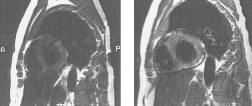 Fig. 5. Sagittal MRI of cardiac iron before (left) and after (right) therapy with the orally active iron chelating agent deferiprone in the same patient with homozygous β thalassemia whose liver histology and hepatic MRI are shown in Fig 3. Imhomogenity of cardiac signal in the MRI on the left is compatible with significant iron deposition, while improvement in signal intensity after nine months of chelating therapy indicates that the cardiac iron content is reduced compared with that of the previous study. (Reprinted with permission.192 )