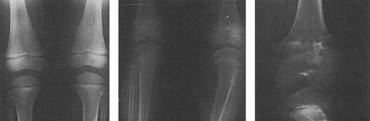 Fig. 8. Radiographs of the femoral and tibial metaphyses of a child treated with deferoxamine therapy. Shown are the metaphyses prior to initiation of nightly subcutaneous deferoxamine (Fig 7A); 3 years after initiation of deferoxamine therapy (Fig 7B); and 6 years after initiation of deferoxamine therapy (Fig 7C). Radiographs show evidence of progressive widening and irregularity of the unossified metaphyseal matrix, which has irregular sclerotic margins. Similar processes in the proximal tibial metaphyses produced both varus and valgus deformities requiring bracing and osteotomy. (Reprinted with permission.144 )