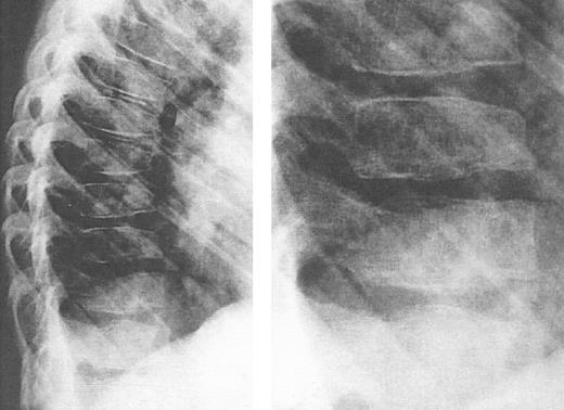 Fig. 9. Lateral view of the thoracic spine in an 11-year, 9-month-old girl with thalassemia major treated with intensive deferoxamine throughout childhood. The spine shows decreased vertebral height with intervertebral disc calcification, flattening and lengthening and anterior tapering or the vertebrae, wedging and moderate kyphosis in this region. Detailed inset shows a bone-within-bone appearance, demarcating a zone of pronounced calicification. (Reprinted by permission from Pediatric Radiology, Spinal deformities in deferoxamine-treated beta-thalassemia major patients, Hartkamp MJ, Babyn PS, Olivieri NF, Volume 23, pp 525-528, Figure 2, 1993, Copyright Springer-Verlag GmbH & Co, KG. 1993.)244