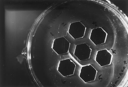 Fig. 1. Representative double immunodiffusion for three patients receiving syngeneic lymphocytes cultured with FCS. Center well, undiluted FCS; well 1, patient 12 preinfusion serum; well 2, patient 12 serum after first infusion; well 3, patient 2 preinfusion serum; well 4, patient 2 serum after first infusion; well 5, patient 8 preinfusion serum; well 6, patient 8 serum after the fourth infusion.