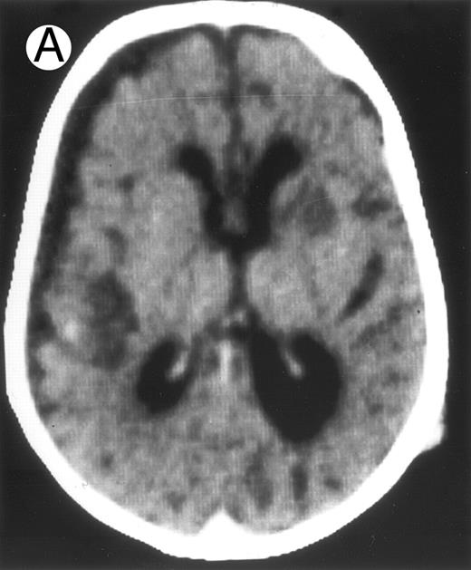 Fig. 2. Three different aspects of brain imaging in HLH patients. (A) CT scan of a 3-month-old baby showing a large subdural effusion, several necrotic areas and hypodensities of the white matter. (B) Brain magnetic resonance of a 14-month-old boy showing large confluent areas of hypersignal in T2-weighted images. (C) Large symmetrical necrotic areas of cerebellar white matter in a 41/2-year-old girl (MRI).