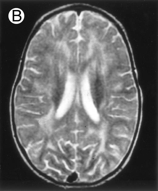 Fig. 2. Three different aspects of brain imaging in HLH patients. (A) CT scan of a 3-month-old baby showing a large subdural effusion, several necrotic areas and hypodensities of the white matter. (B) Brain magnetic resonance of a 14-month-old boy showing large confluent areas of hypersignal in T2-weighted images. (C) Large symmetrical necrotic areas of cerebellar white matter in a 41/2-year-old girl (MRI).