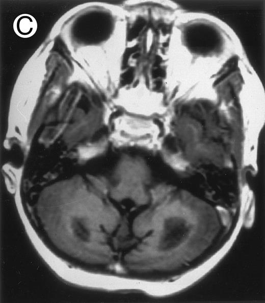 Fig. 2. Three different aspects of brain imaging in HLH patients. (A) CT scan of a 3-month-old baby showing a large subdural effusion, several necrotic areas and hypodensities of the white matter. (B) Brain magnetic resonance of a 14-month-old boy showing large confluent areas of hypersignal in T2-weighted images. (C) Large symmetrical necrotic areas of cerebellar white matter in a 41/2-year-old girl (MRI).