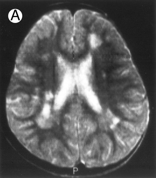 Fig. 3. Evolution of brain lesions during HLH. (A) MRI of a 41/2-year-old girl showing focal white matter hypersignal on T2-weighted images. (B) MRI of the same child 1 year later with an important atrophy of both the white matter and the cortices.