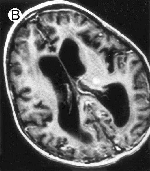 Fig. 3. Evolution of brain lesions during HLH. (A) MRI of a 41/2-year-old girl showing focal white matter hypersignal on T2-weighted images. (B) MRI of the same child 1 year later with an important atrophy of both the white matter and the cortices.