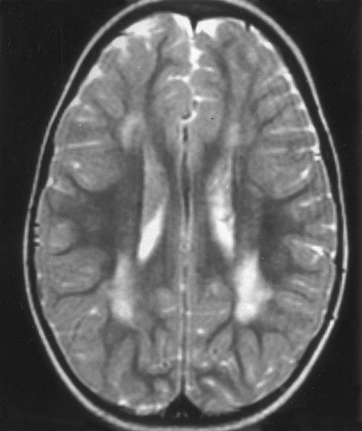 Fig. 4. MRI of a symptom-free 31/2-year-old child who received BMT at 18 months showing the persistent white matter abnormalities.