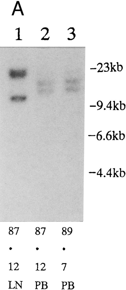 Fig. 2. (A) Sequential analysis of proviral HTLV-I integration in patient 1. Cellular DNA of MNC was digested by EcoRI and hybridized with the pX probe. Two bands larger than 9 kb, (M type), were detected in LN at onset (lane 1), while same sized M type bands, distinct from those in lane 1, were detected both in PB at onset (lane 2) and in PB at relapse (lane 3). (B) Sequential analysis of TCRb gene rearrangement with HindIII in patient 1. (C) Control DNA from HL-60. Samples in lanes 1 to 3 represent those in lanes 1 to 3 in (A). Lane 1, one rearranged band, lanes 2 and 3, two rearranged bands of the same size that were distinct from the rearranged band in lane 1 (GL, germ line; R, rearranged band). (C-1) Sequential analysis of proviral HTLV-I integration in patient 2. One band >9 kb, (C type) was detected in all PB during the course with the pX probe, while one band <9 kb, (D type) was detected in LN at crisis (lane 7). (C-2) Samples in lanes 1 to 8 represent those in lanes 1 to 8 in (C-1). With the gag-pol probe, the same size of C type band as that shown in (C-1) was detected in lane 1 to 6 and 8, while the D type band with the pX probe was not detected with the gag-pol probe in lane 7. (D) Sequential analysis of proviral HTLV-I integration in patient 3. The same C type band was detected in PB at onset and at remission (lanes 1 and 3) with the pX probe. M type bands, of a size distinct from the C type, were detected in LN at crisis (lane 2). (E) Sequential analysis of proviral HTLV-I integration in patient 4. The same size of M type bands was detected at onset (lane 1) and just before chemotherapy (lane 2) in PB with the pX probe. The density of one of the two bands decreased and that of the second increased at crisis (lane 3), whereas the second was only detected at the terminal stage (lane 4). (F) Sequential analysis of TCRb rearrangement with HindIII in patient 4. Samples in lanes 1 to 4 represent those in lanes 1 to 4 in (E). One rearranged band of the same size was detected in lanes 1 to 4.