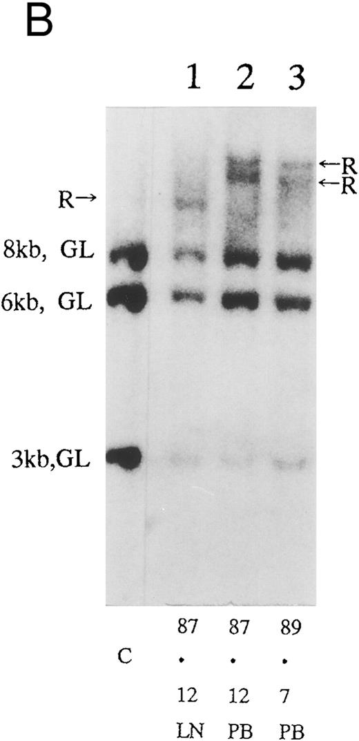Fig. 2. (A) Sequential analysis of proviral HTLV-I integration in patient 1. Cellular DNA of MNC was digested by EcoRI and hybridized with the pX probe. Two bands larger than 9 kb, (M type), were detected in LN at onset (lane 1), while same sized M type bands, distinct from those in lane 1, were detected both in PB at onset (lane 2) and in PB at relapse (lane 3). (B) Sequential analysis of TCRb gene rearrangement with HindIII in patient 1. (C) Control DNA from HL-60. Samples in lanes 1 to 3 represent those in lanes 1 to 3 in (A). Lane 1, one rearranged band, lanes 2 and 3, two rearranged bands of the same size that were distinct from the rearranged band in lane 1 (GL, germ line; R, rearranged band). (C-1) Sequential analysis of proviral HTLV-I integration in patient 2. One band >9 kb, (C type) was detected in all PB during the course with the pX probe, while one band <9 kb, (D type) was detected in LN at crisis (lane 7). (C-2) Samples in lanes 1 to 8 represent those in lanes 1 to 8 in (C-1). With the gag-pol probe, the same size of C type band as that shown in (C-1) was detected in lane 1 to 6 and 8, while the D type band with the pX probe was not detected with the gag-pol probe in lane 7. (D) Sequential analysis of proviral HTLV-I integration in patient 3. The same C type band was detected in PB at onset and at remission (lanes 1 and 3) with the pX probe. M type bands, of a size distinct from the C type, were detected in LN at crisis (lane 2). (E) Sequential analysis of proviral HTLV-I integration in patient 4. The same size of M type bands was detected at onset (lane 1) and just before chemotherapy (lane 2) in PB with the pX probe. The density of one of the two bands decreased and that of the second increased at crisis (lane 3), whereas the second was only detected at the terminal stage (lane 4). (F) Sequential analysis of TCRb rearrangement with HindIII in patient 4. Samples in lanes 1 to 4 represent those in lanes 1 to 4 in (E). One rearranged band of the same size was detected in lanes 1 to 4.