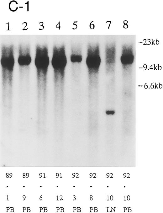 Fig. 2. (A) Sequential analysis of proviral HTLV-I integration in patient 1. Cellular DNA of MNC was digested by EcoRI and hybridized with the pX probe. Two bands larger than 9 kb, (M type), were detected in LN at onset (lane 1), while same sized M type bands, distinct from those in lane 1, were detected both in PB at onset (lane 2) and in PB at relapse (lane 3). (B) Sequential analysis of TCRb gene rearrangement with HindIII in patient 1. (C) Control DNA from HL-60. Samples in lanes 1 to 3 represent those in lanes 1 to 3 in (A). Lane 1, one rearranged band, lanes 2 and 3, two rearranged bands of the same size that were distinct from the rearranged band in lane 1 (GL, germ line; R, rearranged band). (C-1) Sequential analysis of proviral HTLV-I integration in patient 2. One band >9 kb, (C type) was detected in all PB during the course with the pX probe, while one band <9 kb, (D type) was detected in LN at crisis (lane 7). (C-2) Samples in lanes 1 to 8 represent those in lanes 1 to 8 in (C-1). With the gag-pol probe, the same size of C type band as that shown in (C-1) was detected in lane 1 to 6 and 8, while the D type band with the pX probe was not detected with the gag-pol probe in lane 7. (D) Sequential analysis of proviral HTLV-I integration in patient 3. The same C type band was detected in PB at onset and at remission (lanes 1 and 3) with the pX probe. M type bands, of a size distinct from the C type, were detected in LN at crisis (lane 2). (E) Sequential analysis of proviral HTLV-I integration in patient 4. The same size of M type bands was detected at onset (lane 1) and just before chemotherapy (lane 2) in PB with the pX probe. The density of one of the two bands decreased and that of the second increased at crisis (lane 3), whereas the second was only detected at the terminal stage (lane 4). (F) Sequential analysis of TCRb rearrangement with HindIII in patient 4. Samples in lanes 1 to 4 represent those in lanes 1 to 4 in (E). One rearranged band of the same size was detected in lanes 1 to 4.
