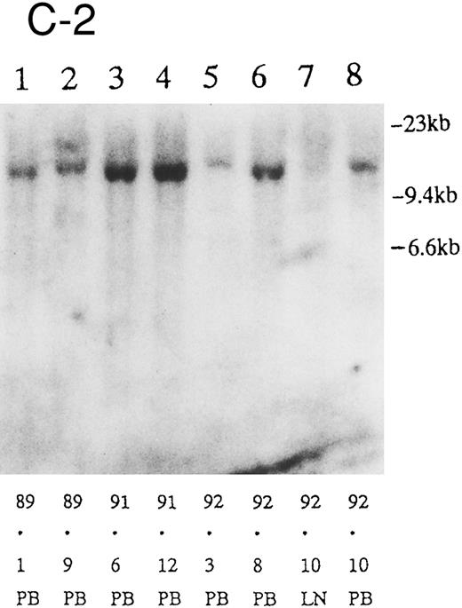 Fig. 2. (A) Sequential analysis of proviral HTLV-I integration in patient 1. Cellular DNA of MNC was digested by EcoRI and hybridized with the pX probe. Two bands larger than 9 kb, (M type), were detected in LN at onset (lane 1), while same sized M type bands, distinct from those in lane 1, were detected both in PB at onset (lane 2) and in PB at relapse (lane 3). (B) Sequential analysis of TCRb gene rearrangement with HindIII in patient 1. (C) Control DNA from HL-60. Samples in lanes 1 to 3 represent those in lanes 1 to 3 in (A). Lane 1, one rearranged band, lanes 2 and 3, two rearranged bands of the same size that were distinct from the rearranged band in lane 1 (GL, germ line; R, rearranged band). (C-1) Sequential analysis of proviral HTLV-I integration in patient 2. One band >9 kb, (C type) was detected in all PB during the course with the pX probe, while one band <9 kb, (D type) was detected in LN at crisis (lane 7). (C-2) Samples in lanes 1 to 8 represent those in lanes 1 to 8 in (C-1). With the gag-pol probe, the same size of C type band as that shown in (C-1) was detected in lane 1 to 6 and 8, while the D type band with the pX probe was not detected with the gag-pol probe in lane 7. (D) Sequential analysis of proviral HTLV-I integration in patient 3. The same C type band was detected in PB at onset and at remission (lanes 1 and 3) with the pX probe. M type bands, of a size distinct from the C type, were detected in LN at crisis (lane 2). (E) Sequential analysis of proviral HTLV-I integration in patient 4. The same size of M type bands was detected at onset (lane 1) and just before chemotherapy (lane 2) in PB with the pX probe. The density of one of the two bands decreased and that of the second increased at crisis (lane 3), whereas the second was only detected at the terminal stage (lane 4). (F) Sequential analysis of TCRb rearrangement with HindIII in patient 4. Samples in lanes 1 to 4 represent those in lanes 1 to 4 in (E). One rearranged band of the same size was detected in lanes 1 to 4.