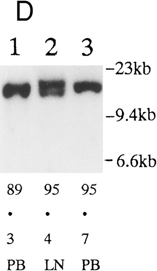 Fig. 2. (A) Sequential analysis of proviral HTLV-I integration in patient 1. Cellular DNA of MNC was digested by EcoRI and hybridized with the pX probe. Two bands larger than 9 kb, (M type), were detected in LN at onset (lane 1), while same sized M type bands, distinct from those in lane 1, were detected both in PB at onset (lane 2) and in PB at relapse (lane 3). (B) Sequential analysis of TCRb gene rearrangement with HindIII in patient 1. (C) Control DNA from HL-60. Samples in lanes 1 to 3 represent those in lanes 1 to 3 in (A). Lane 1, one rearranged band, lanes 2 and 3, two rearranged bands of the same size that were distinct from the rearranged band in lane 1 (GL, germ line; R, rearranged band). (C-1) Sequential analysis of proviral HTLV-I integration in patient 2. One band >9 kb, (C type) was detected in all PB during the course with the pX probe, while one band <9 kb, (D type) was detected in LN at crisis (lane 7). (C-2) Samples in lanes 1 to 8 represent those in lanes 1 to 8 in (C-1). With the gag-pol probe, the same size of C type band as that shown in (C-1) was detected in lane 1 to 6 and 8, while the D type band with the pX probe was not detected with the gag-pol probe in lane 7. (D) Sequential analysis of proviral HTLV-I integration in patient 3. The same C type band was detected in PB at onset and at remission (lanes 1 and 3) with the pX probe. M type bands, of a size distinct from the C type, were detected in LN at crisis (lane 2). (E) Sequential analysis of proviral HTLV-I integration in patient 4. The same size of M type bands was detected at onset (lane 1) and just before chemotherapy (lane 2) in PB with the pX probe. The density of one of the two bands decreased and that of the second increased at crisis (lane 3), whereas the second was only detected at the terminal stage (lane 4). (F) Sequential analysis of TCRb rearrangement with HindIII in patient 4. Samples in lanes 1 to 4 represent those in lanes 1 to 4 in (E). One rearranged band of the same size was detected in lanes 1 to 4.