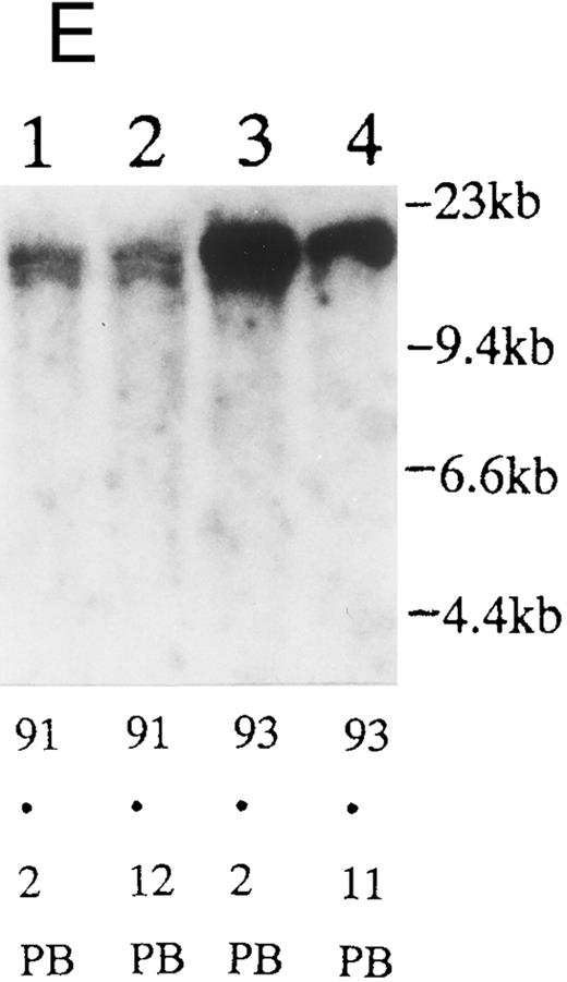 Fig. 2. (A) Sequential analysis of proviral HTLV-I integration in patient 1. Cellular DNA of MNC was digested by EcoRI and hybridized with the pX probe. Two bands larger than 9 kb, (M type), were detected in LN at onset (lane 1), while same sized M type bands, distinct from those in lane 1, were detected both in PB at onset (lane 2) and in PB at relapse (lane 3). (B) Sequential analysis of TCRb gene rearrangement with HindIII in patient 1. (C) Control DNA from HL-60. Samples in lanes 1 to 3 represent those in lanes 1 to 3 in (A). Lane 1, one rearranged band, lanes 2 and 3, two rearranged bands of the same size that were distinct from the rearranged band in lane 1 (GL, germ line; R, rearranged band). (C-1) Sequential analysis of proviral HTLV-I integration in patient 2. One band >9 kb, (C type) was detected in all PB during the course with the pX probe, while one band <9 kb, (D type) was detected in LN at crisis (lane 7). (C-2) Samples in lanes 1 to 8 represent those in lanes 1 to 8 in (C-1). With the gag-pol probe, the same size of C type band as that shown in (C-1) was detected in lane 1 to 6 and 8, while the D type band with the pX probe was not detected with the gag-pol probe in lane 7. (D) Sequential analysis of proviral HTLV-I integration in patient 3. The same C type band was detected in PB at onset and at remission (lanes 1 and 3) with the pX probe. M type bands, of a size distinct from the C type, were detected in LN at crisis (lane 2). (E) Sequential analysis of proviral HTLV-I integration in patient 4. The same size of M type bands was detected at onset (lane 1) and just before chemotherapy (lane 2) in PB with the pX probe. The density of one of the two bands decreased and that of the second increased at crisis (lane 3), whereas the second was only detected at the terminal stage (lane 4). (F) Sequential analysis of TCRb rearrangement with HindIII in patient 4. Samples in lanes 1 to 4 represent those in lanes 1 to 4 in (E). One rearranged band of the same size was detected in lanes 1 to 4.