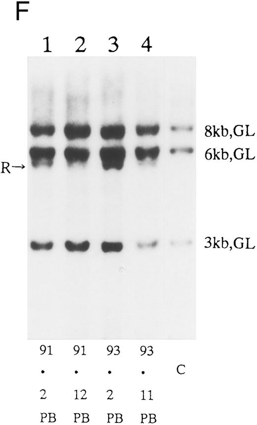 Fig. 2. (A) Sequential analysis of proviral HTLV-I integration in patient 1. Cellular DNA of MNC was digested by EcoRI and hybridized with the pX probe. Two bands larger than 9 kb, (M type), were detected in LN at onset (lane 1), while same sized M type bands, distinct from those in lane 1, were detected both in PB at onset (lane 2) and in PB at relapse (lane 3). (B) Sequential analysis of TCRb gene rearrangement with HindIII in patient 1. (C) Control DNA from HL-60. Samples in lanes 1 to 3 represent those in lanes 1 to 3 in (A). Lane 1, one rearranged band, lanes 2 and 3, two rearranged bands of the same size that were distinct from the rearranged band in lane 1 (GL, germ line; R, rearranged band). (C-1) Sequential analysis of proviral HTLV-I integration in patient 2. One band >9 kb, (C type) was detected in all PB during the course with the pX probe, while one band <9 kb, (D type) was detected in LN at crisis (lane 7). (C-2) Samples in lanes 1 to 8 represent those in lanes 1 to 8 in (C-1). With the gag-pol probe, the same size of C type band as that shown in (C-1) was detected in lane 1 to 6 and 8, while the D type band with the pX probe was not detected with the gag-pol probe in lane 7. (D) Sequential analysis of proviral HTLV-I integration in patient 3. The same C type band was detected in PB at onset and at remission (lanes 1 and 3) with the pX probe. M type bands, of a size distinct from the C type, were detected in LN at crisis (lane 2). (E) Sequential analysis of proviral HTLV-I integration in patient 4. The same size of M type bands was detected at onset (lane 1) and just before chemotherapy (lane 2) in PB with the pX probe. The density of one of the two bands decreased and that of the second increased at crisis (lane 3), whereas the second was only detected at the terminal stage (lane 4). (F) Sequential analysis of TCRb rearrangement with HindIII in patient 4. Samples in lanes 1 to 4 represent those in lanes 1 to 4 in (E). One rearranged band of the same size was detected in lanes 1 to 4.