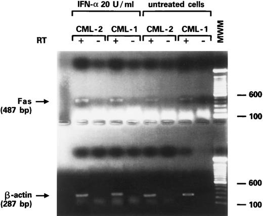 Fig. 3. Expression of Fas-R mRNA in CD34+ cells from two CML patients after stimulation with IFN-α. Bands represent the product of the RT-PCR for Fas (upper gel) and β-actin (lower gel) from purified CD34+ cells of two patients with CML in chronic phase.