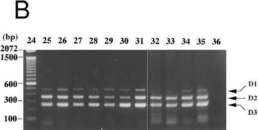 Fig. 6. Cyclin D1 expression in peripheral blood, bone marrow, and lymph nodes. (A) Peripheral blood (100 μL each, lanes 2-22) of patients in the hematology outpatient clinic were subjected to RNA extraction and the competitive RT-PCR as described in Materials and Methods. (B) Lymph node cells of a patient with necrotizing lymphadenitis (lane 25) and of lymphoma patients (lanes 26-31) and bone marrow aspirates (50 μL each, lanes 32-35) of lymphoma patients without bone marrow involvement were also subjected to RNA extraction and the competitive RT-PCR. Diseases affecting these patients were as follows: lanes 2, 11, and 22, pernicious anemia; lanes 3 and 5, collagen disease; lane 4, idiopathic thrombocytopenic purpura; lane 6, lymphoplasmacytic lymphoma with bcl-1 rearrangement and cyclin D1 overexpression; lane 7, acute myeloid leukemia in complete remission; lanes 8 and 26-28, follicular lymphoma; lane 9, pulmonary infiltrate with eosinophilia; lanes 10 and 29-31, diffuse lymphoma; lanes 12, 13, 18, and 19, non-Hodgkin's lymphoma in complete remission; lanes 14 and 20, chronic myeloid leukemia in the accelerated phase; lane 15, aplastic anemia; lane 16, myelodysplastic syndrome; lane 17, autoimmune hemolytic anemia; lane 21, iron-deficiency anemia. Negative controls of PCR without added template are in lanes 23 and 36. The sizes (bp) of 100 bp DNA ladders (lanes 1 and 24) are shown on the left.