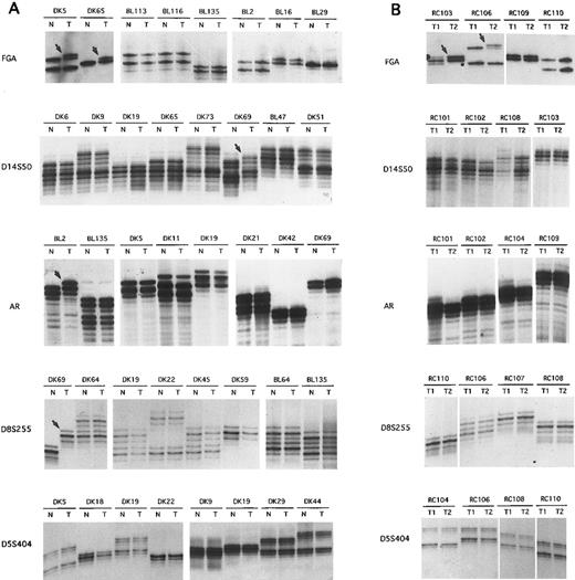 Fig. 1. Microsatellite instability analysis in NHL. (A) Representative results of MSI analysis in matched normal (N) and tumor (T) DNAs from the same individuals for five MSI loci (listed at the left of each panel). (B) Representative results of MSI analysis in matched DNA samples derived from tumors at diagnosis (T1) and after tumor progression (T2) for the same five MSI loci (listed at the left of each panel). Arrows point to samples where MSI is detectable.