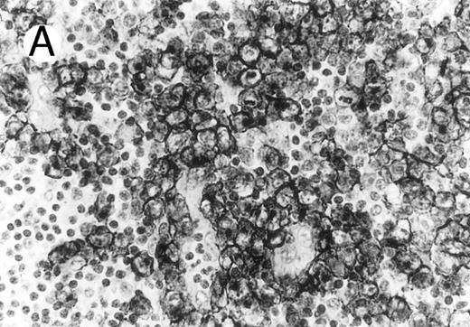 Fig. 1. Cytotoxic granule antigen expression in a common form of ALCL (Table 2; case 11). (A) Immunostain for CD30 highlights sheets of large tumor cells. (B) The tumor cells of this case display granular cytoplasmic TIA-1 immunoreaction with paranuclear accumulation in the Golgi region. (C) Strong cytoplasmic perforin reaction is shown in the same case. (sABC-peroxidase technique, hematoxylin counterstain, original magnification × 400.)