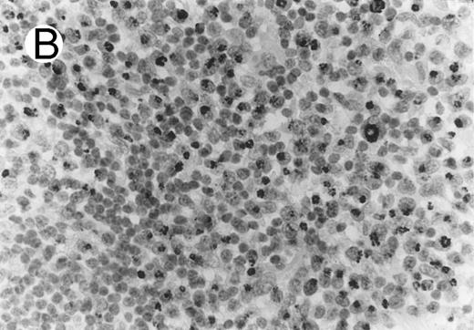 Fig. 1. Cytotoxic granule antigen expression in a common form of ALCL (Table 2; case 11). (A) Immunostain for CD30 highlights sheets of large tumor cells. (B) The tumor cells of this case display granular cytoplasmic TIA-1 immunoreaction with paranuclear accumulation in the Golgi region. (C) Strong cytoplasmic perforin reaction is shown in the same case. (sABC-peroxidase technique, hematoxylin counterstain, original magnification × 400.)