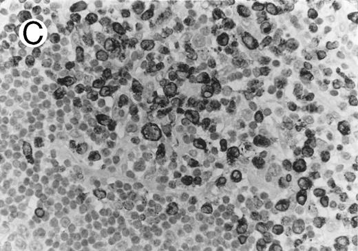 Fig. 1. Cytotoxic granule antigen expression in a common form of ALCL (Table 2; case 11). (A) Immunostain for CD30 highlights sheets of large tumor cells. (B) The tumor cells of this case display granular cytoplasmic TIA-1 immunoreaction with paranuclear accumulation in the Golgi region. (C) Strong cytoplasmic perforin reaction is shown in the same case. (sABC-peroxidase technique, hematoxylin counterstain, original magnification × 400.)